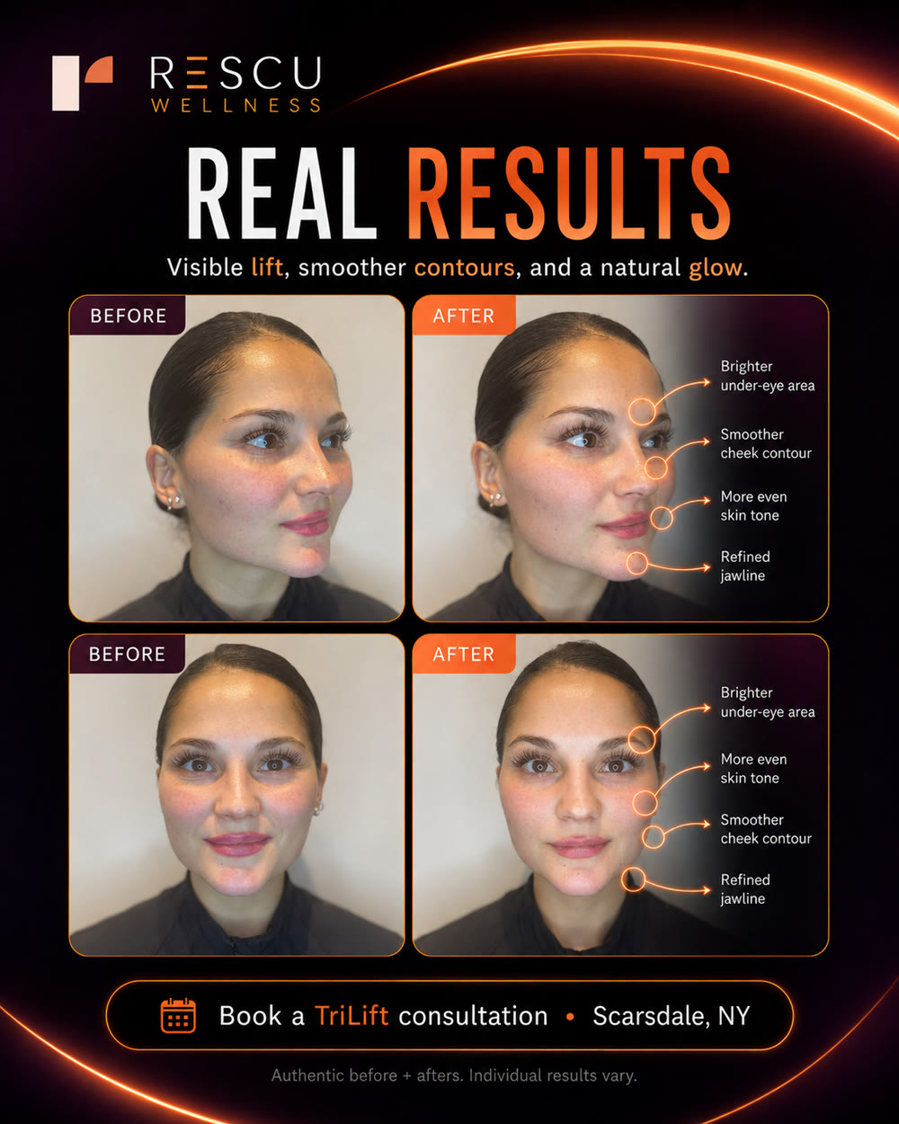 TriLift before and after — real Rescu client showing brighter under-eye area, smoother cheek contour, more even skin tone, and refined jawline