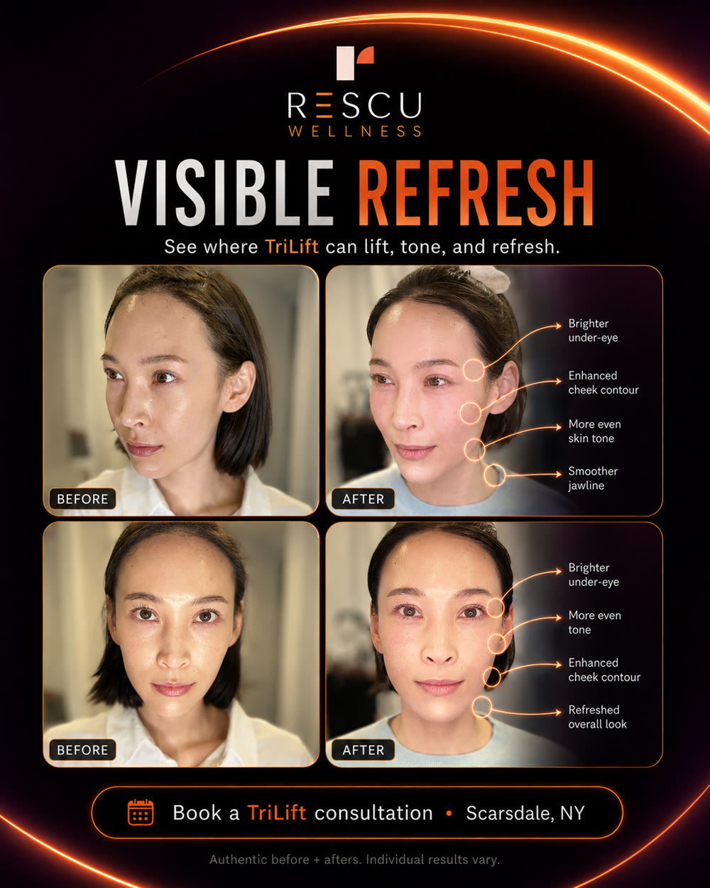 TriLift before and after — real Rescu client showing brighter under-eye, enhanced cheek contour, and smoother jawline