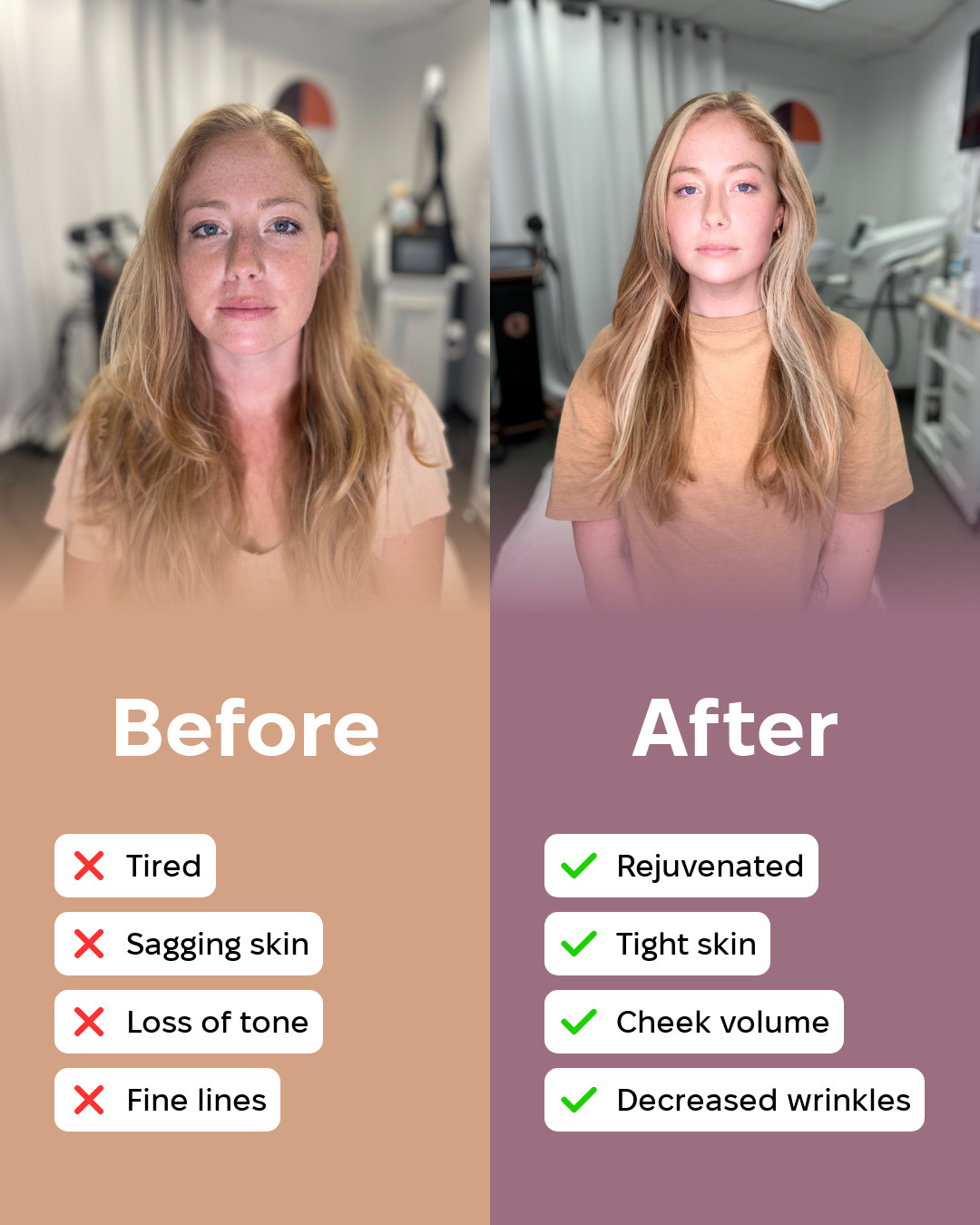 TriLift before and after at Rescu Wellness — same client showing tighter skin, cheek volume and reduced fine lines after the DMS plus RF protocol