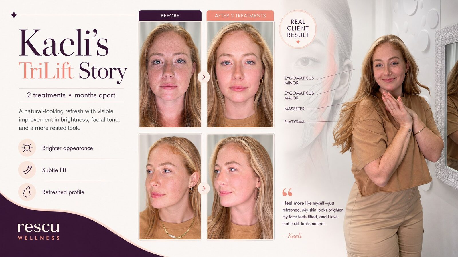 TriLift results at Rescu Wellness Scarsdale